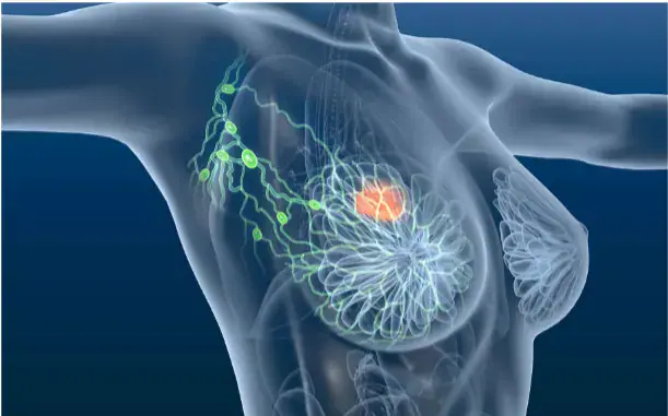 La chimiothérapie, un traitement efficace contre certains cas de cancer du sein