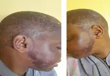 Rare Case of Hydroxychloroquine-Induced Hyperpigmentation in a Dark-Skinned Woman with Lupus