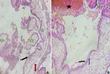 Gestational Abnormalities Diagnosed by Histopathological Examination of Products of Conception in Burkina Faso