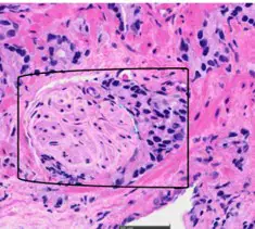 Prostate Cancer in Burkina Faso: 10-Year Study Reveals Advanced Diagnosis and Screening Challenges