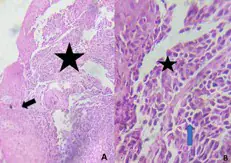 Oesophageal Lesions Prevalent in Bobo-Dioulasso, Burkina Faso