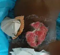 Postoperative Complications of Non-Traumatic Acute Abdomen in Children in Bangui