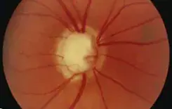 Obesity Linked to Greater Severity of Primary Open-Angle Glaucoma in Cameroon