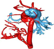 Rare Case of Pulmonary Sequestration Associated with Double Cardiac Shunt in Infant