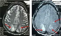 Neurological Manifestations and Brain Lesions of Eclampsia at Brazzaville University Hospital