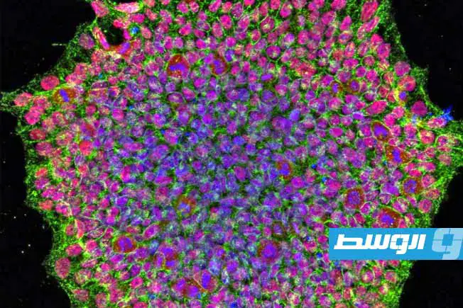 أول عملية زراعة خلايا جذعية لعلاج مرض باركنسون في اليابان