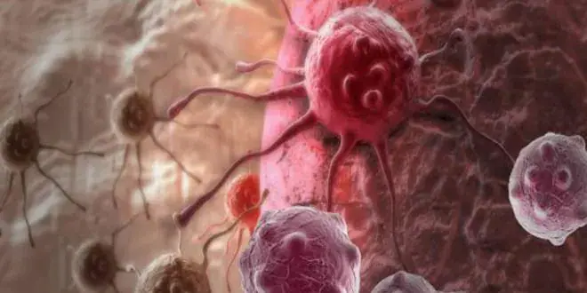 Tunisia Records 10,720 New Female Cancer Cases in 2025