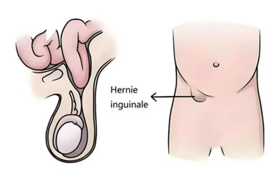 Hernie inguinale : Une maladie courante chez les Maliens