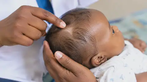 Fontanelle du bébé : Entre croyances, gestes traditionnels et vérités médicales