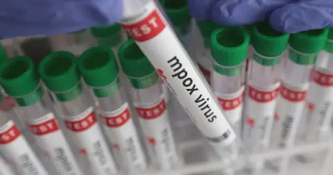 Mpox is a viral infection that spreads through close contact and typically causes flu-like symptoms and pus-filled lesions. It is usually mild, but can be lethal. File photo.