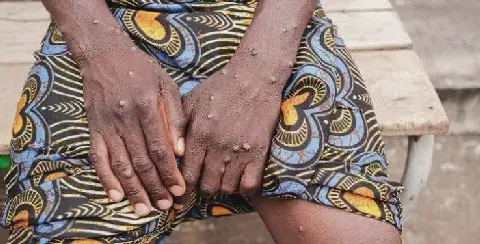 Angola Reports 19 New Mpox Cases in 24 Hours