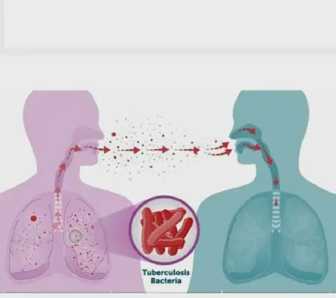 TB can hide in the eye, cause blindness —Babalola