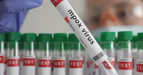 Mpox is a viral disease that causes fever and skin lesions and spreads through close physical contact. File picture: Reuters