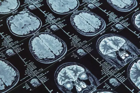 ULS de Coimbra Launches Project for Early Diagnosis of Alzheimer's Disease