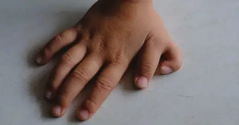 Why do some people have six fingernails on one hand?