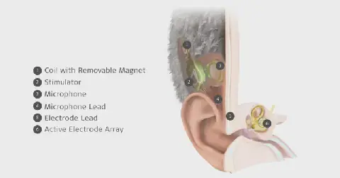 MED-EL Launches World’s First Commercially Available Totally Invisible Cochlear Implant