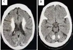 Rare Neurological Disorder Revealed in Cameroonian Patient