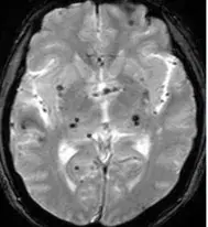 Study Identifies Risk Factors for Cerebral Hemorrhage After Thrombolysis in Ischemic Stroke Patients
