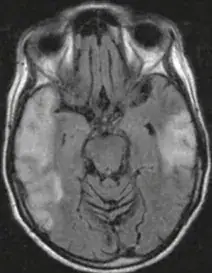 Encephalitis Profile in Guinean Neurology Department Reveals Viral Etiologies and Diagnostic Challenges