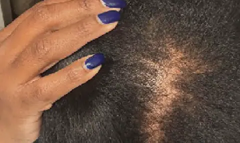 Stress and Hair Loss: Understanding Alopecia in Namibia
