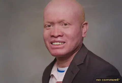 Soja Ramiandrisoa Fulgence Warns of Rising Threats to Albinos in Madagascar