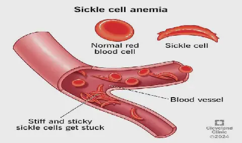 Nigeria Urged to Lead Sickle Cell Solutions