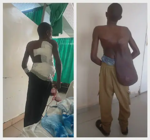 Rwandan Man's 12-Year Battle with Spinal Tumor Ends in Successful Surgery
