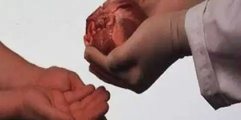 70% of Tunisian Families Refuse Organ Donation from Deceased Relatives