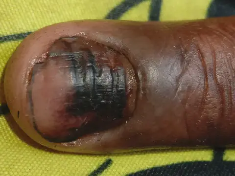 Guinea Health Experts Warn Against Neglecting Panaris Infections