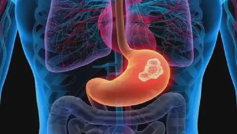 Egypt's Stomach Cancer Alert: Key Groups at Risk and Symptoms to Watch