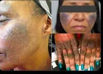 Social Media Fuels Nigeria's Deadly Skincare Trend