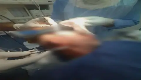 Egyptian Hospital Successfully Removes Skin Tumor from Elderly Patient's Scalp