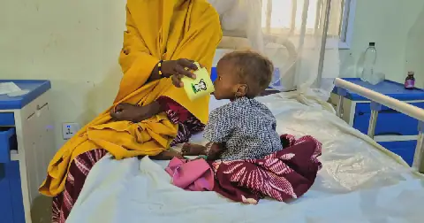 3.9m Nigerian children malnourished -Experts