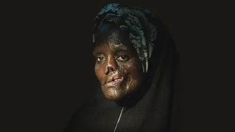 40 Noma patients to undergo reconstructive surgery in Sokoto