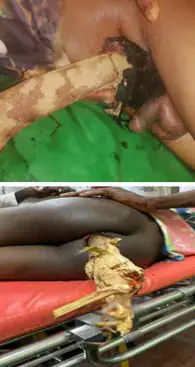 Surgical Management of Perineal Trauma in Men in Bouake