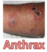 Cameroon's neighboring country Côte d'Ivoire Sees Low Awareness of Anthrax Among Livestock Professionals